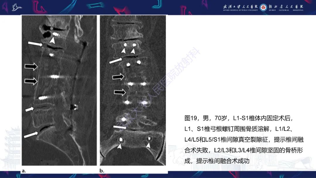 影像PPT - 【PPT】脊柱术后CT评估-38
