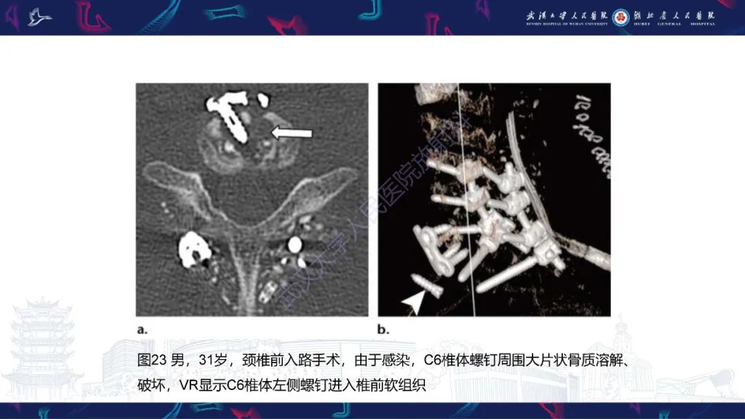 影像PPT - 【PPT】脊柱术后CT评估-41