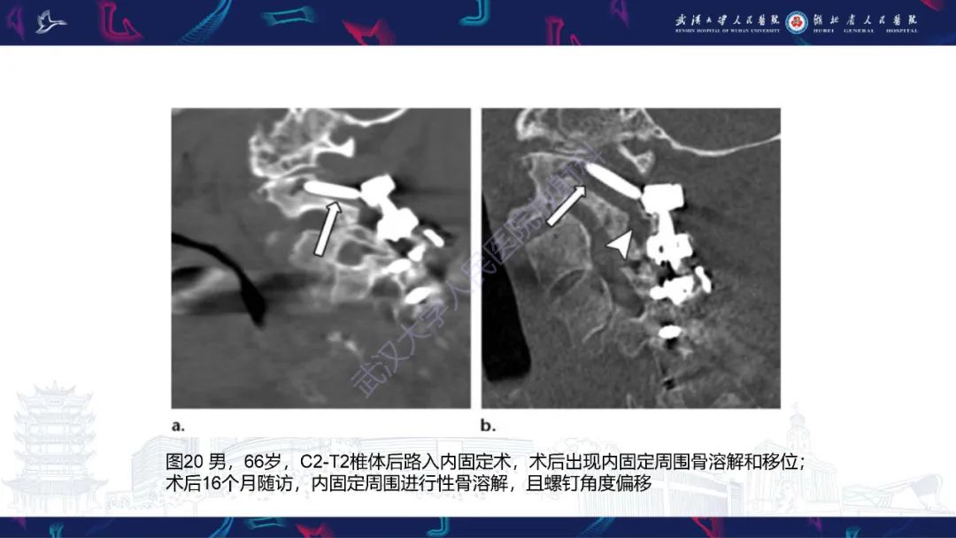 影像PPT - 【PPT】脊柱术后CT评估-39