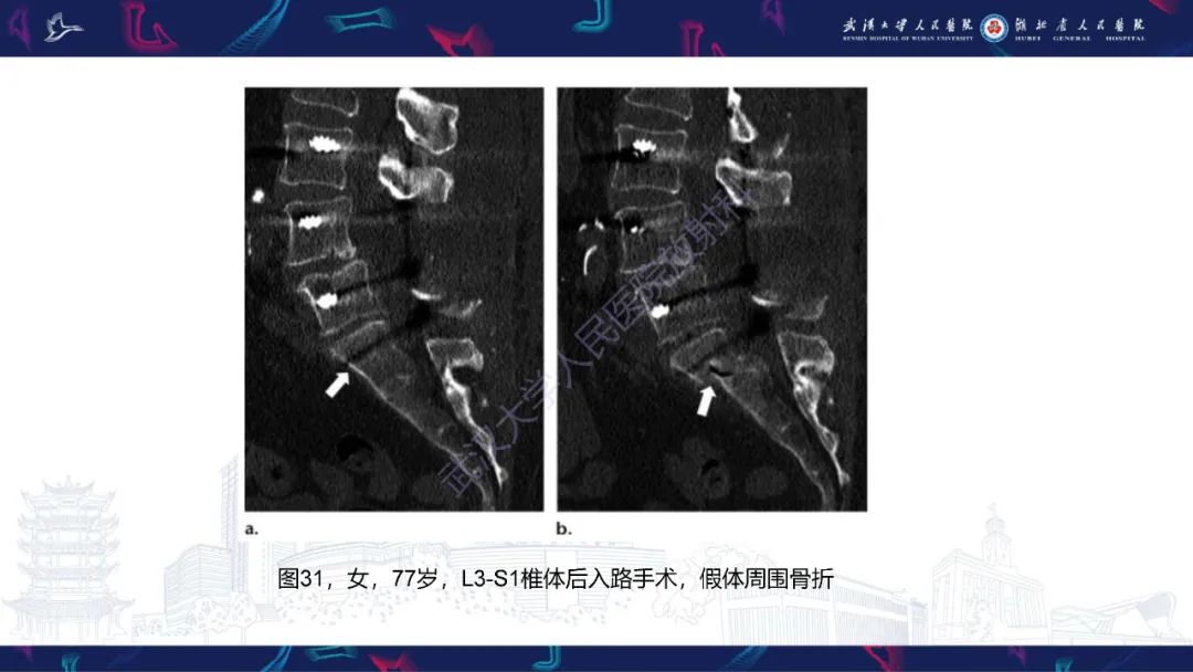 影像PPT - 【PPT】脊柱术后CT评估-46