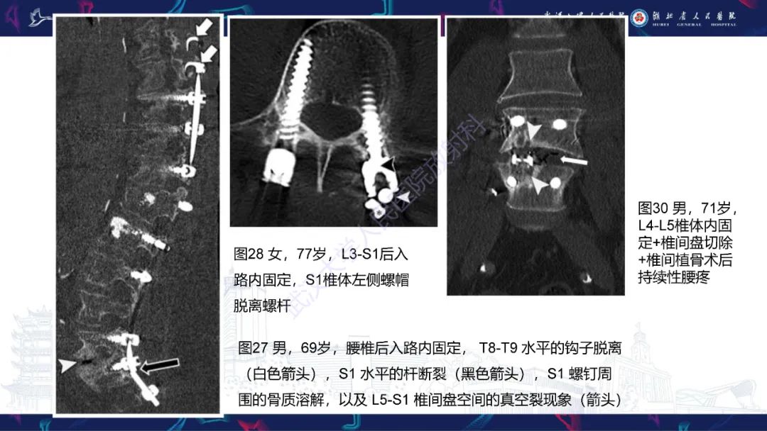 影像PPT - 【PPT】脊柱术后CT评估-45