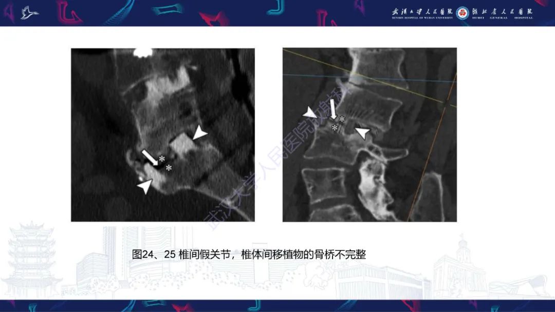 影像PPT - 【PPT】脊柱术后CT评估-42
