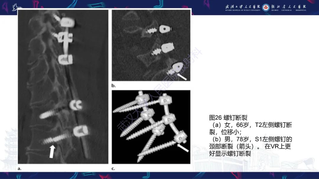 影像PPT - 【PPT】脊柱术后CT评估-44