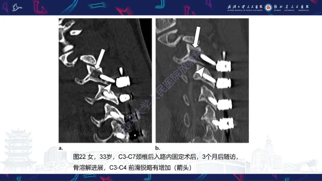 影像PPT - 【PPT】脊柱术后CT评估-40