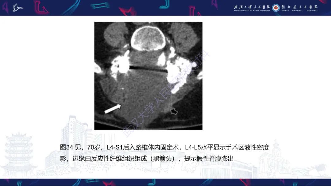 影像PPT - 【PPT】脊柱术后CT评估-51
