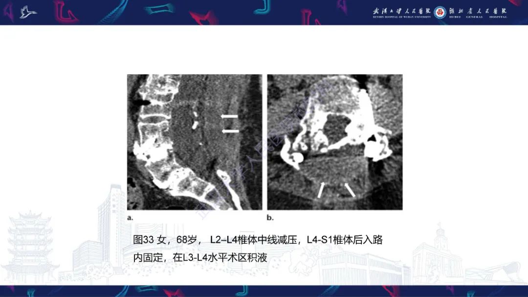 影像PPT - 【PPT】脊柱术后CT评估-50