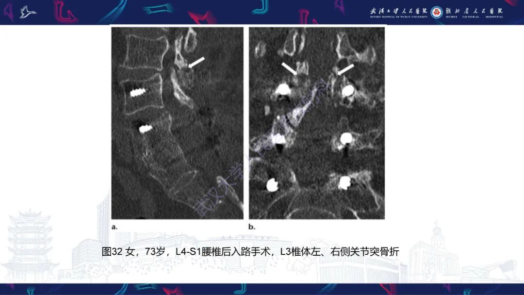 影像PPT - 【PPT】脊柱术后CT评估-47