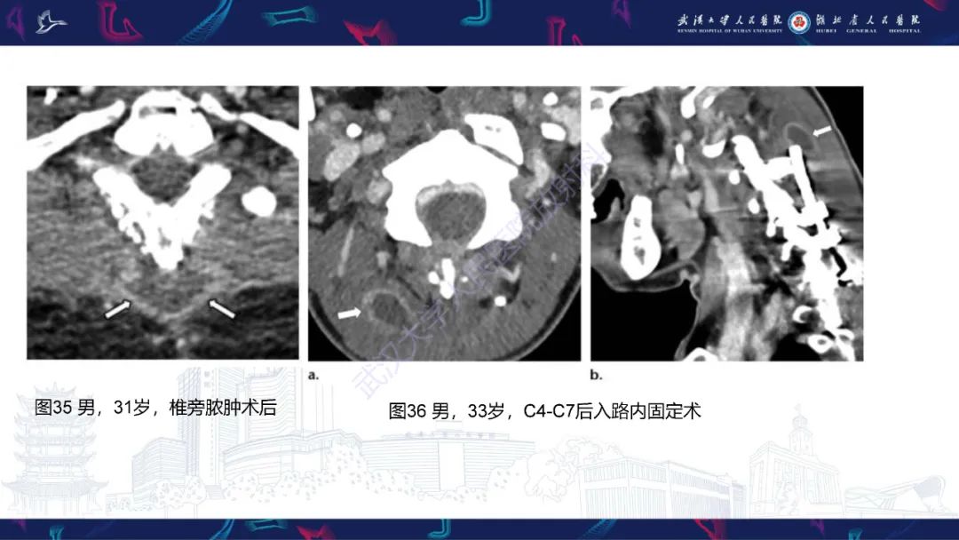 影像PPT - 【PPT】脊柱术后CT评估-52