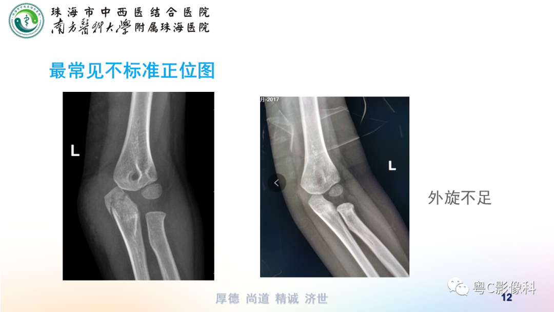 影像PPT - 【PPT】儿童肘关节正侧位x线摄影-12