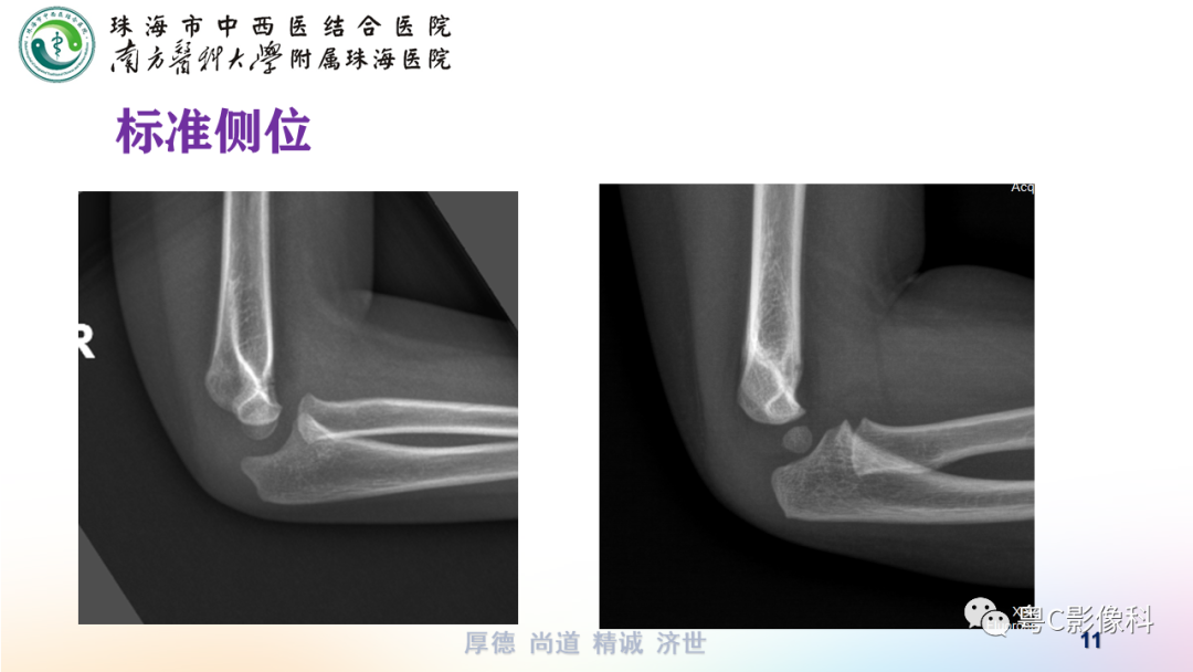 影像PPT - 【PPT】儿童肘关节正侧位x线摄影-11