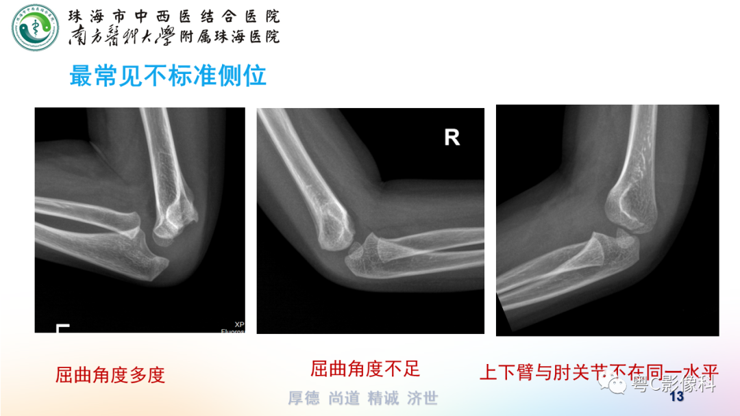 影像PPT - 【PPT】儿童肘关节正侧位x线摄影-13