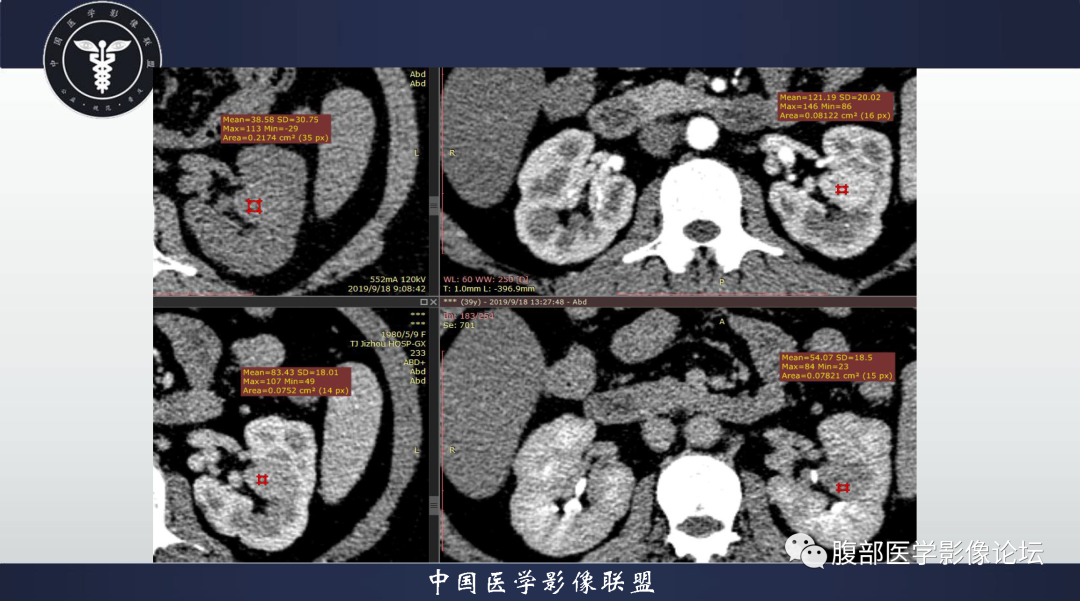 影像PPT - 【病例】肾脏血管平滑肌脂肪瘤1例CT影像-3 影像PPT - 【病例】肾脏血管平滑肌脂肪瘤1例CT影像-3