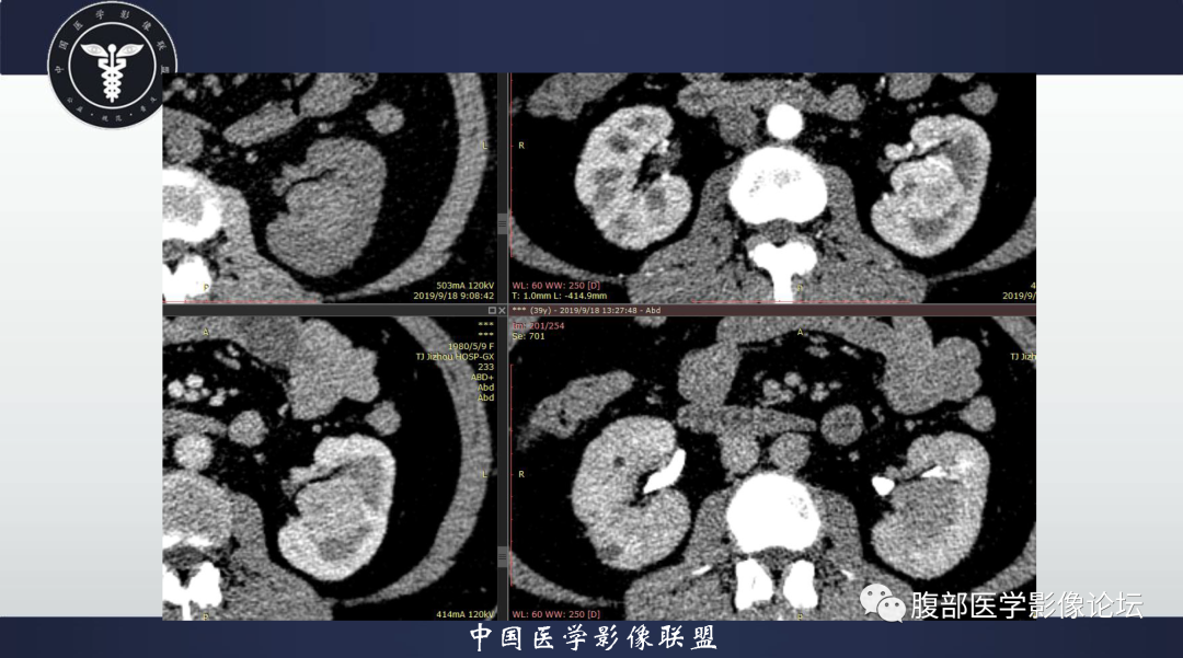 影像PPT - 【病例】肾脏血管平滑肌脂肪瘤1例CT影像-8 影像PPT - 【病例】肾脏血管平滑肌脂肪瘤1例CT影像-8