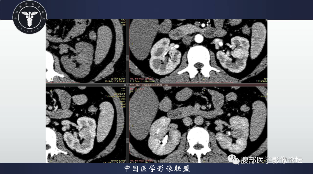 影像PPT - 【病例】肾脏血管平滑肌脂肪瘤1例CT影像-2 影像PPT - 【病例】肾脏血管平滑肌脂肪瘤1例CT影像-2