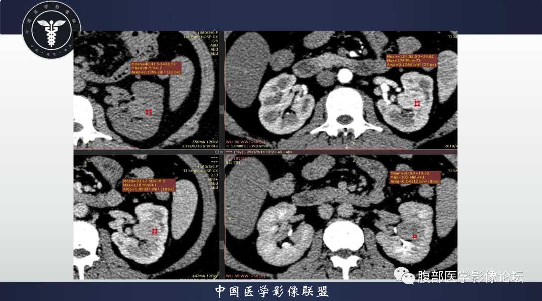 影像PPT - 【病例】肾脏血管平滑肌脂肪瘤1例CT影像-4 影像PPT - 【病例】肾脏血管平滑肌脂肪瘤1例CT影像-4