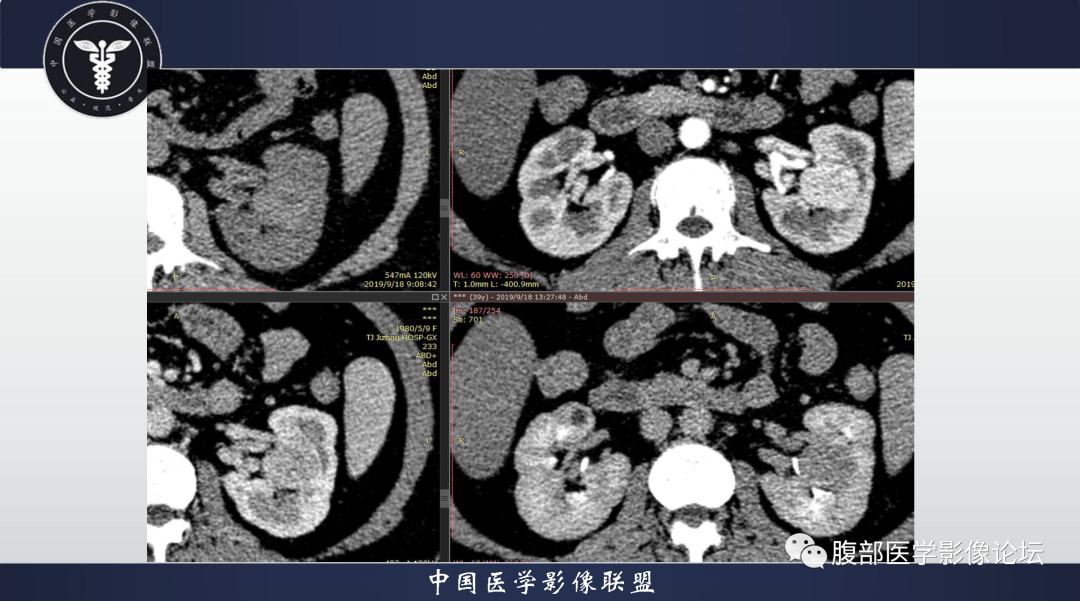 影像PPT - 【病例】肾脏血管平滑肌脂肪瘤1例CT影像-5 影像PPT - 【病例】肾脏血管平滑肌脂肪瘤1例CT影像-5