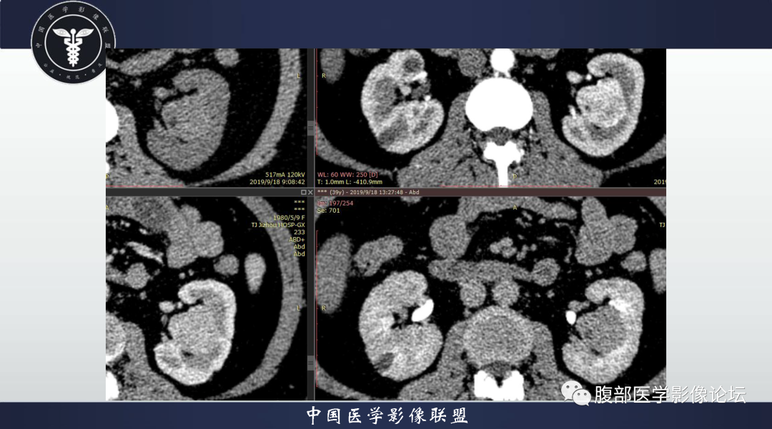 影像PPT - 【病例】肾脏血管平滑肌脂肪瘤1例CT影像-7 影像PPT - 【病例】肾脏血管平滑肌脂肪瘤1例CT影像-7