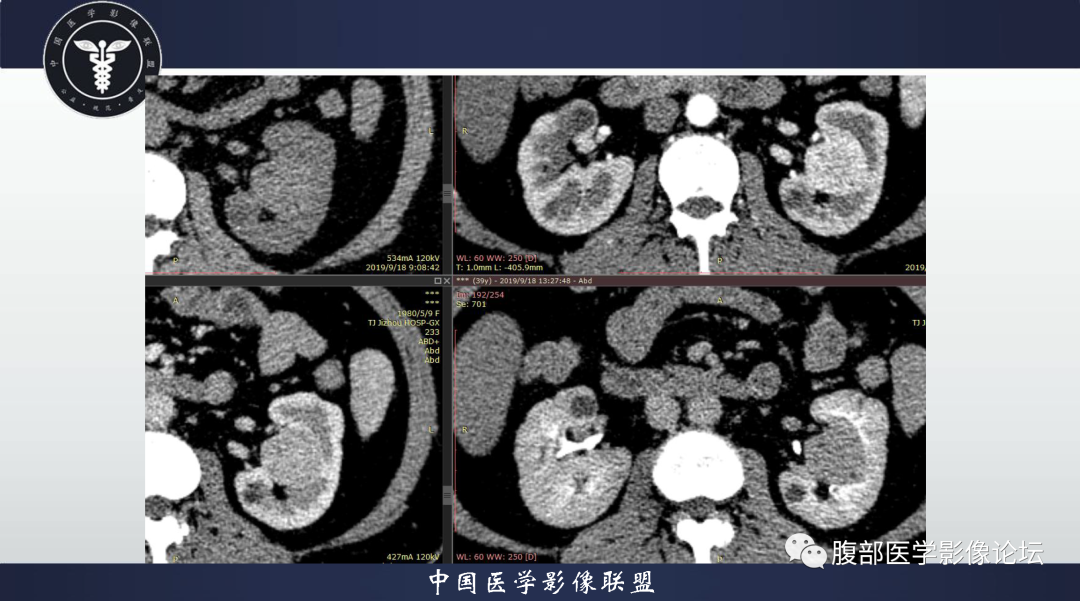 影像PPT - 【病例】肾脏血管平滑肌脂肪瘤1例CT影像-6 影像PPT - 【病例】肾脏血管平滑肌脂肪瘤1例CT影像-6
