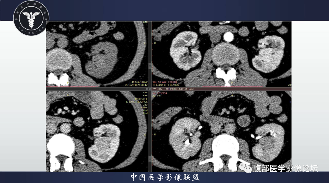 影像PPT - 【病例】肾脏血管平滑肌脂肪瘤1例CT影像-9 影像PPT - 【病例】肾脏血管平滑肌脂肪瘤1例CT影像-9