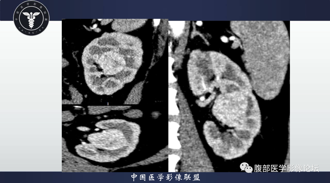 影像PPT - 【病例】肾脏血管平滑肌脂肪瘤1例CT影像-11 影像PPT - 【病例】肾脏血管平滑肌脂肪瘤1例CT影像-11