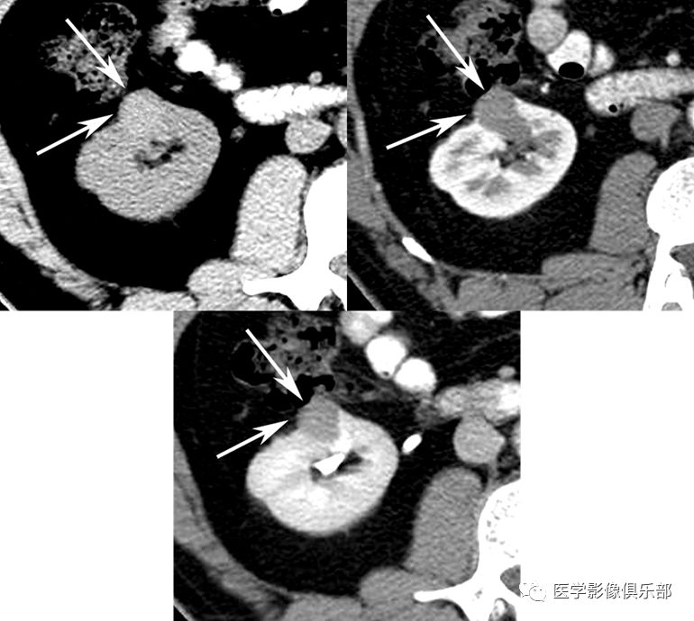 影像PPT - 【病例】肾脏血管平滑肌脂肪瘤1例CT影像-22 影像PPT - 【病例】肾脏血管平滑肌脂肪瘤1例CT影像-22