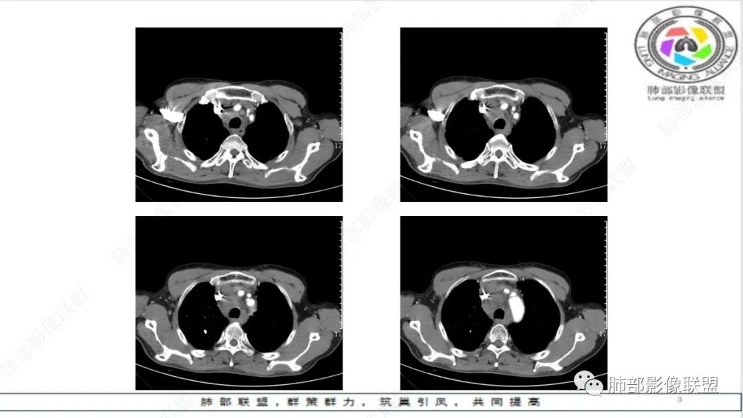 影像PPT - 【病例】精准打击—小细胞肺癌-3 影像PPT - 【病例】精准打击—小细胞肺癌-3
