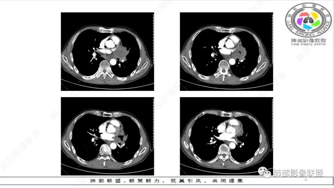 影像PPT - 【病例】精准打击—小细胞肺癌-8 影像PPT - 【病例】精准打击—小细胞肺癌-8