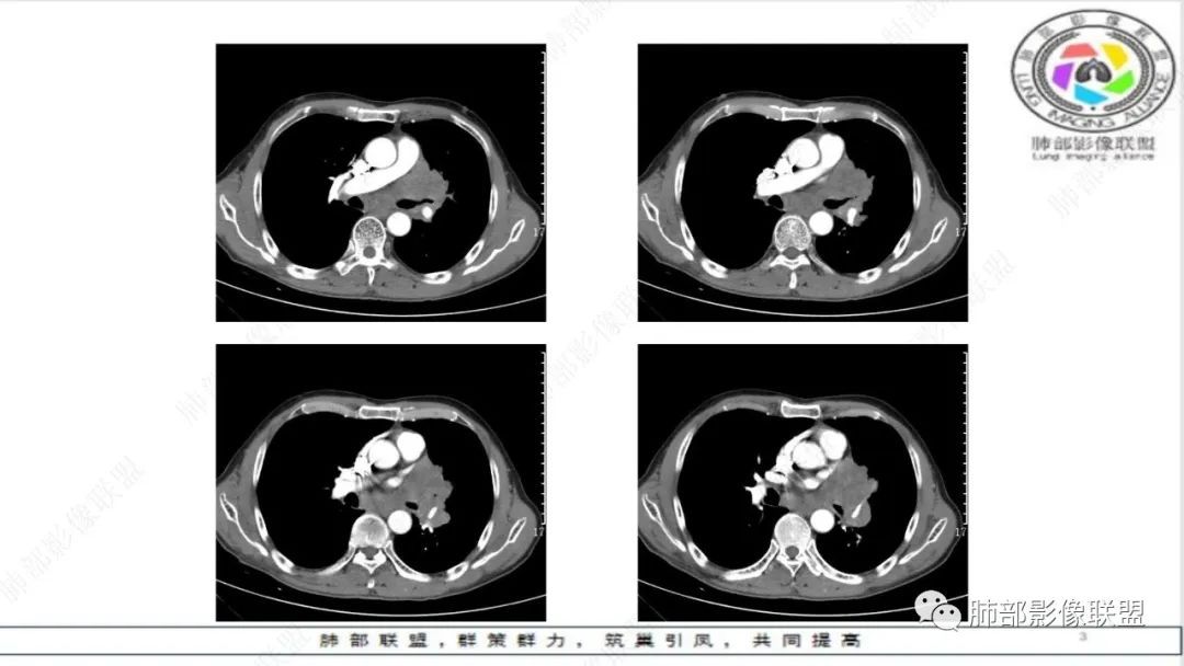 影像PPT - 【病例】精准打击—小细胞肺癌-7 影像PPT - 【病例】精准打击—小细胞肺癌-7