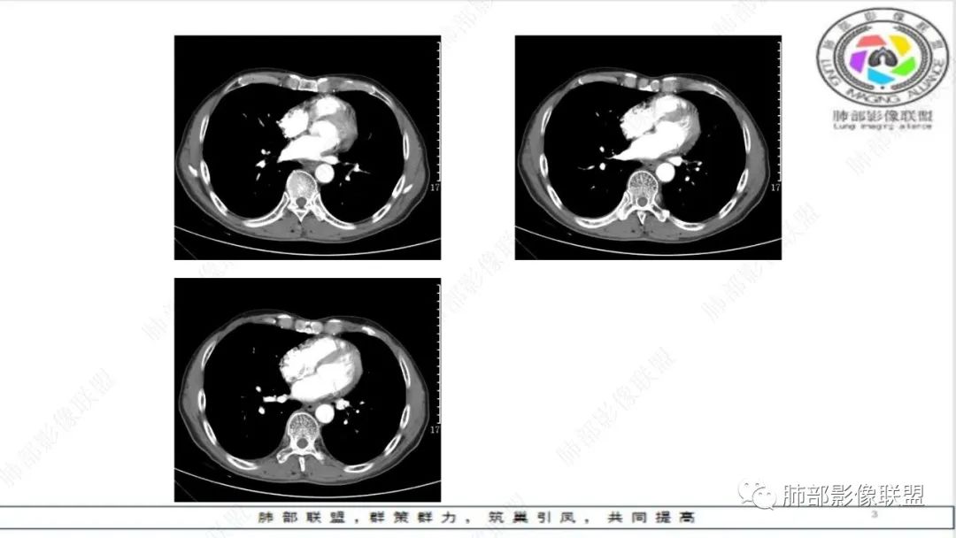 影像PPT - 【病例】精准打击—小细胞肺癌-9 影像PPT - 【病例】精准打击—小细胞肺癌-9