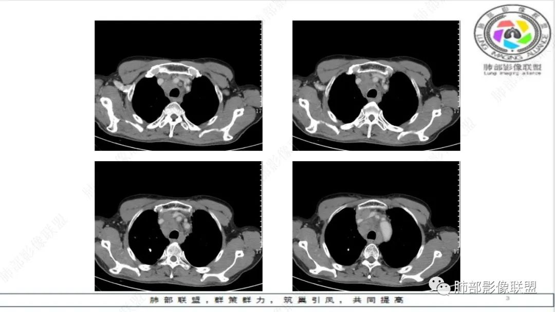 影像PPT - 【病例】精准打击—小细胞肺癌-10 影像PPT - 【病例】精准打击—小细胞肺癌-10