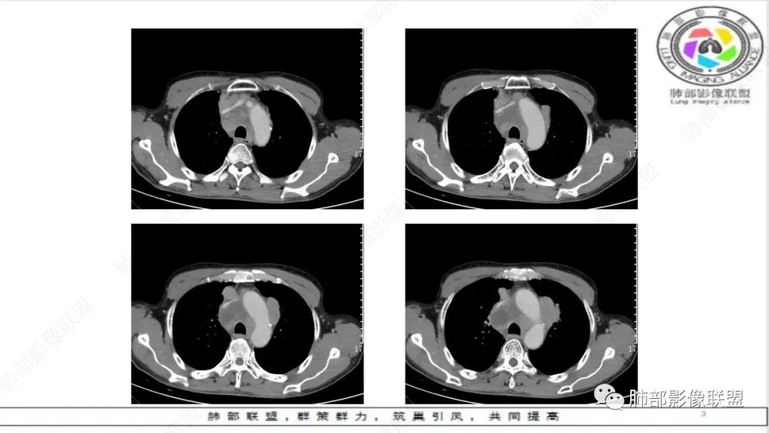 影像PPT - 【病例】精准打击—小细胞肺癌-11 影像PPT - 【病例】精准打击—小细胞肺癌-11