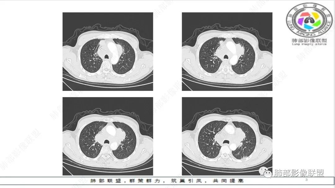 影像PPT - 【病例】精准打击—小细胞肺癌-19 影像PPT - 【病例】精准打击—小细胞肺癌-19