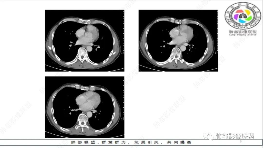 影像PPT - 【病例】精准打击—小细胞肺癌-16 影像PPT - 【病例】精准打击—小细胞肺癌-16