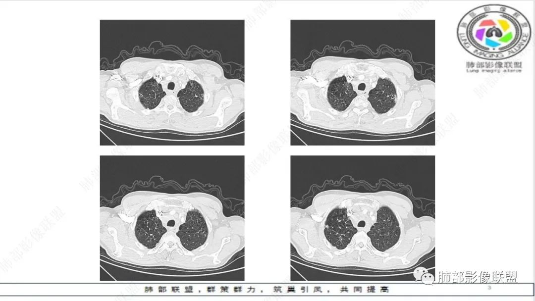 影像PPT - 【病例】精准打击—小细胞肺癌-17 影像PPT - 【病例】精准打击—小细胞肺癌-17