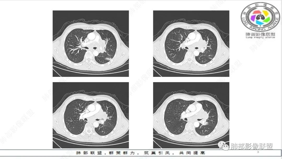 影像PPT - 【病例】精准打击—小细胞肺癌-21 影像PPT - 【病例】精准打击—小细胞肺癌-21