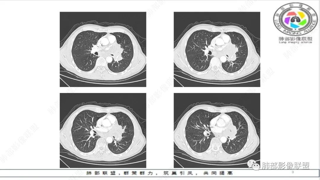 影像PPT - 【病例】精准打击—小细胞肺癌-22 影像PPT - 【病例】精准打击—小细胞肺癌-22