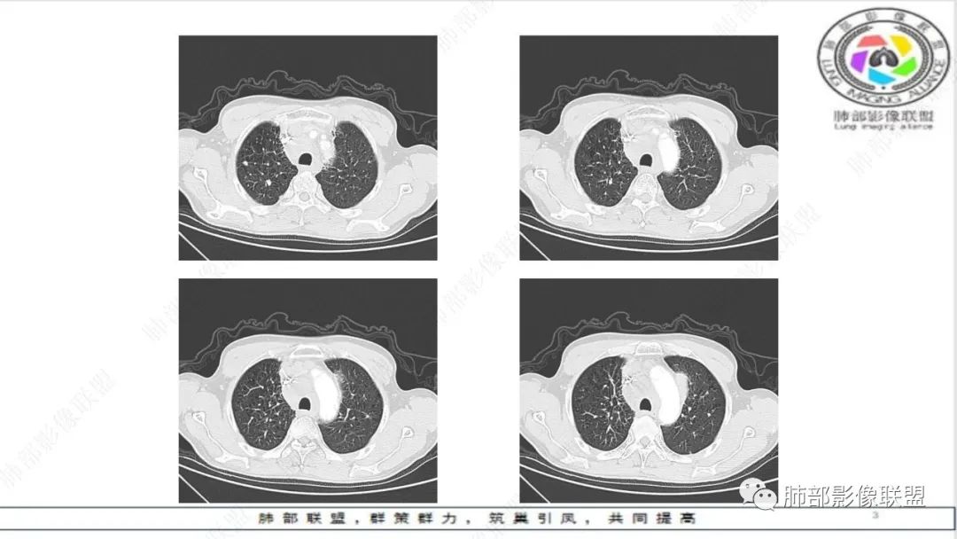 影像PPT - 【病例】精准打击—小细胞肺癌-18 影像PPT - 【病例】精准打击—小细胞肺癌-18