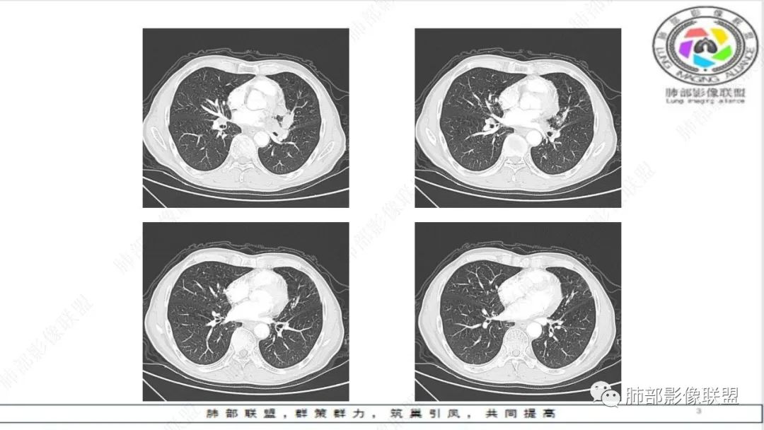 影像PPT - 【病例】精准打击—小细胞肺癌-23 影像PPT - 【病例】精准打击—小细胞肺癌-23