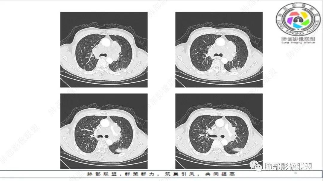 影像PPT - 【病例】精准打击—小细胞肺癌-20 影像PPT - 【病例】精准打击—小细胞肺癌-20