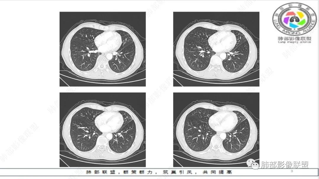 影像PPT - 【病例】精准打击—小细胞肺癌-24 影像PPT - 【病例】精准打击—小细胞肺癌-24