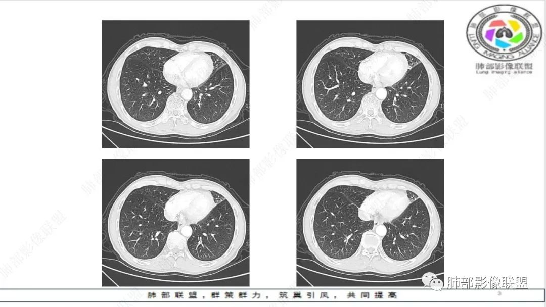 影像PPT - 【病例】精准打击—小细胞肺癌-25 影像PPT - 【病例】精准打击—小细胞肺癌-25