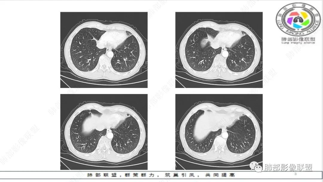 影像PPT - 【病例】精准打击—小细胞肺癌-26 影像PPT - 【病例】精准打击—小细胞肺癌-26