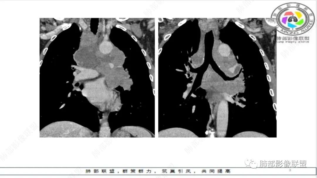 影像PPT - 【病例】精准打击—小细胞肺癌-27 影像PPT - 【病例】精准打击—小细胞肺癌-27
