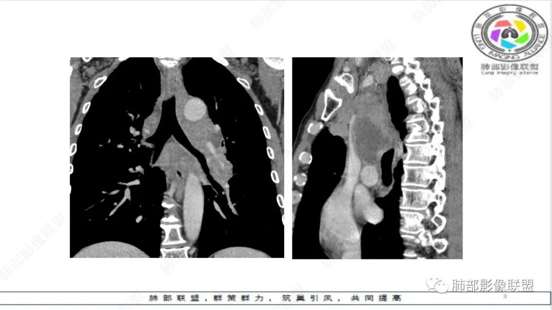 影像PPT - 【病例】精准打击—小细胞肺癌-28 影像PPT - 【病例】精准打击—小细胞肺癌-28