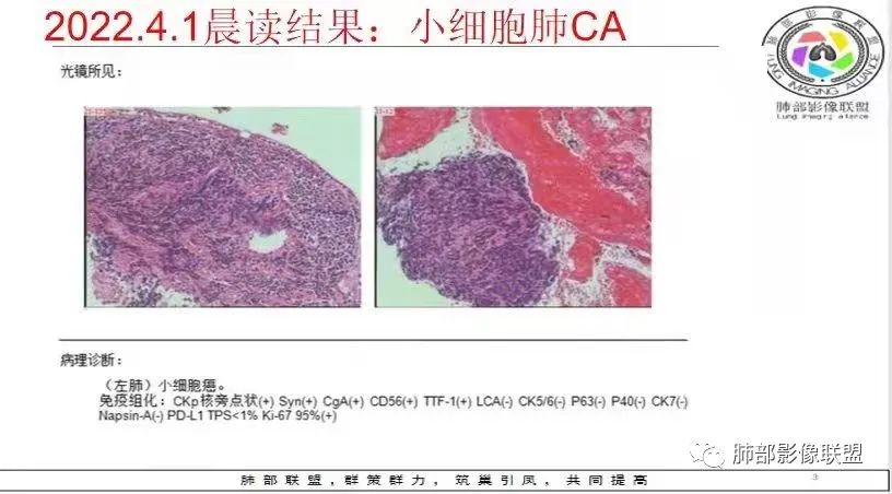 影像PPT - 【病例】精准打击—小细胞肺癌-32 影像PPT - 【病例】精准打击—小细胞肺癌-32
