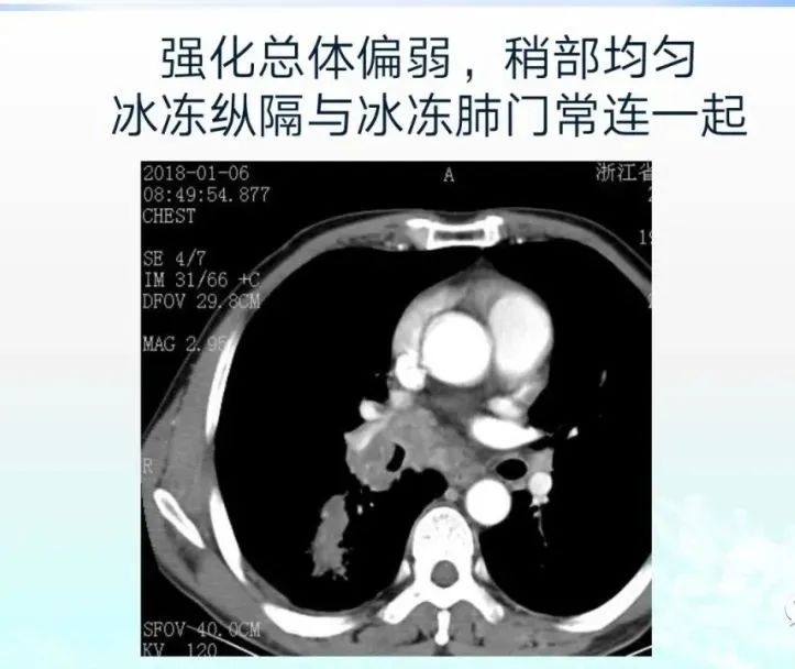 影像PPT - 【病例】精准打击—小细胞肺癌-35 影像PPT - 【病例】精准打击—小细胞肺癌-35