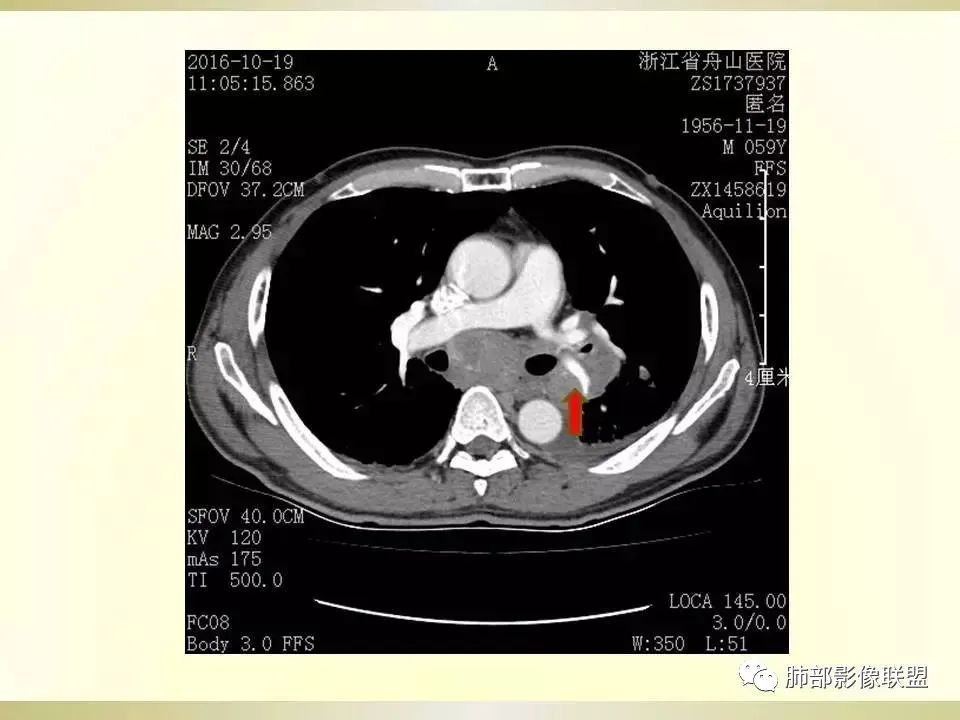 影像PPT - 【病例】精准打击—小细胞肺癌-36 影像PPT - 【病例】精准打击—小细胞肺癌-36
