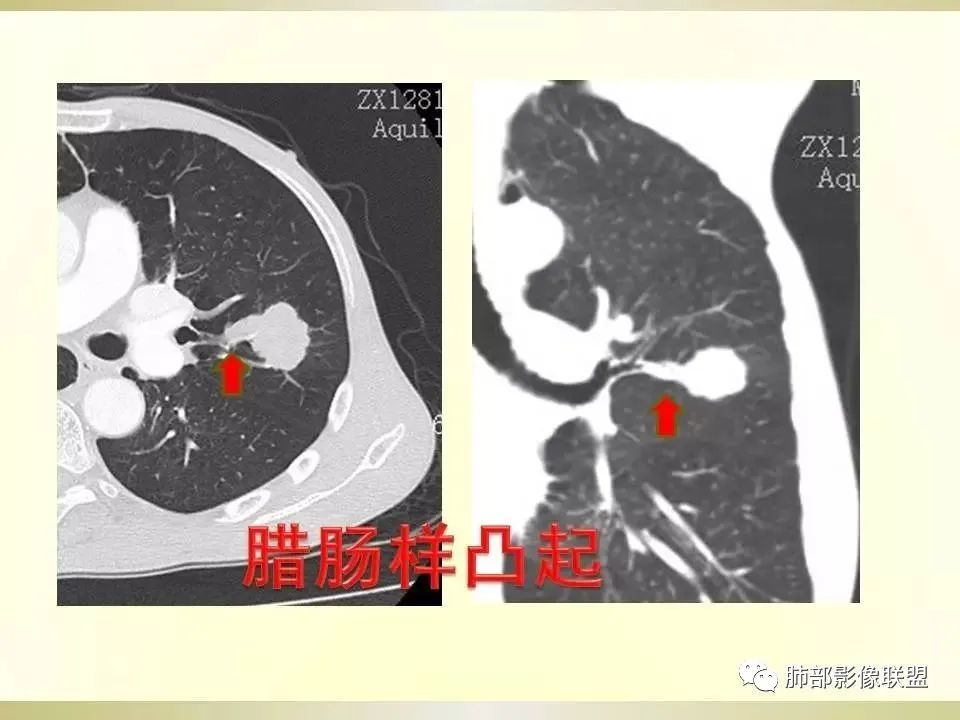 影像PPT - 【病例】精准打击—小细胞肺癌-38 影像PPT - 【病例】精准打击—小细胞肺癌-38