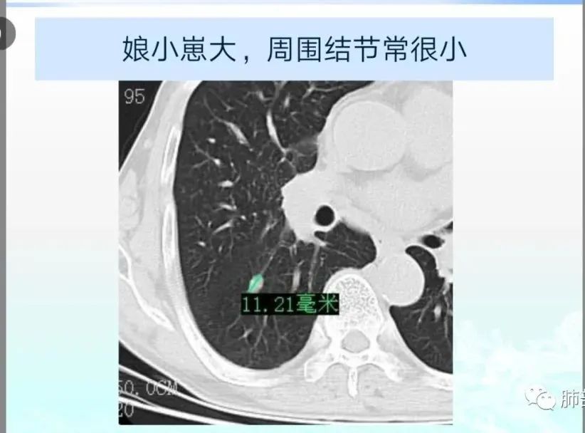 影像PPT - 【病例】精准打击—小细胞肺癌-39 影像PPT - 【病例】精准打击—小细胞肺癌-39