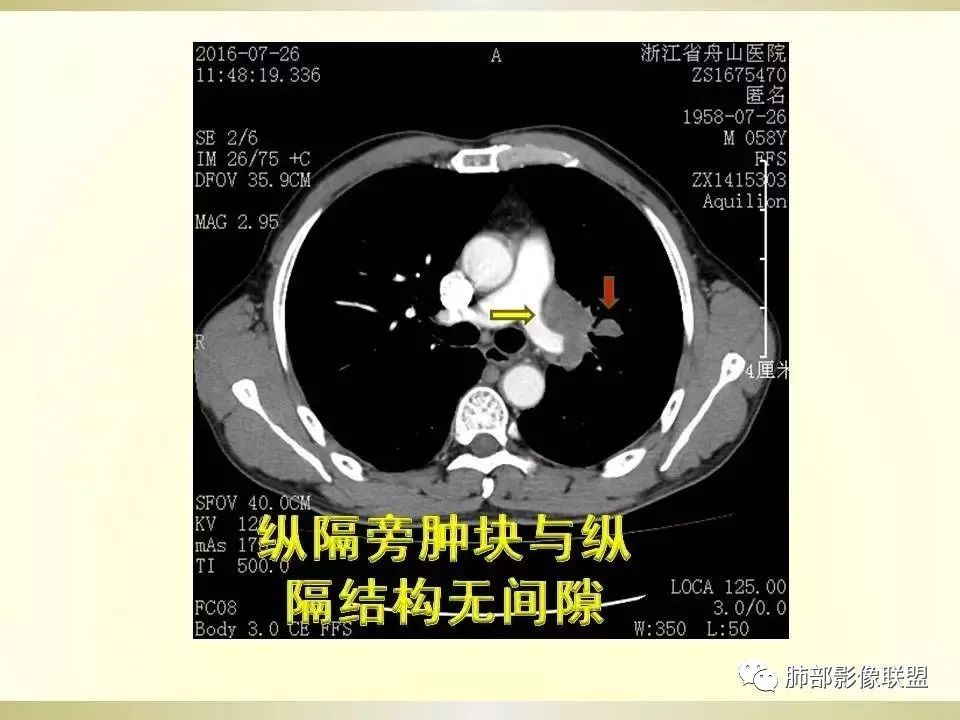 影像PPT - 【病例】精准打击—小细胞肺癌-40 影像PPT - 【病例】精准打击—小细胞肺癌-40